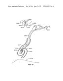 Minimally Invasive Lung Volume Reduction Devices, Methods, and Systems diagram and image