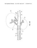 CATHETER-BASED CANCER THERAPY diagram and image