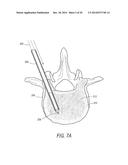 SYSTEMS FOR TREATING A VERTEBRAL BODY diagram and image