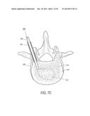 SYSTEMS FOR TREATING A VERTEBRAL BODY diagram and image