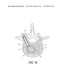 SYSTEMS FOR TREATING A VERTEBRAL BODY diagram and image