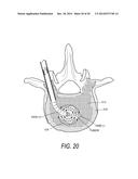 SYSTEMS FOR TREATING A VERTEBRAL BODY diagram and image