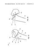 FLEXIBLE BONE SCREW diagram and image