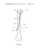 FLEXIBLE BONE SCREW diagram and image