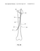 FLEXIBLE BONE SCREW diagram and image