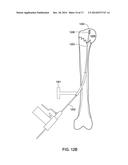 FLEXIBLE BONE SCREW diagram and image