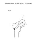 FRACTURE TREATMENT DEVICE diagram and image