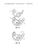 FEMORAL EXPLANT DEVICE diagram and image