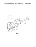 FEMORAL EXPLANT DEVICE diagram and image