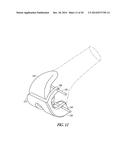 FEMORAL EXPLANT DEVICE diagram and image