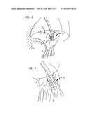 APPARATUS AND METHOD FOR HEART VALVE REPAIR diagram and image