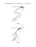 CLOT REMOVAL DEVICE diagram and image