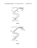 CLOT REMOVAL DEVICE diagram and image