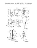 SUTURE FOR CONNECTING A HUMAN OR ANIMAL TISSUE, SOFT ANCHOR AND METHOD FOR     ATTACHING A TISSUE TO A BONE diagram and image