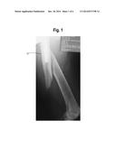 CHANNELED BONE PLATE AND METHODS FOR IMPLANTING THE SAME diagram and image