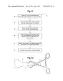 CHANNELED BONE PLATE AND METHODS FOR IMPLANTING THE SAME diagram and image