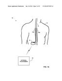 AUTOMATED PROGRAMMING OF ELECTRICAL STIMULATION ELECTRODES USING     POST-IMPLANT IMAGING diagram and image