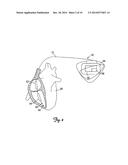 Detection of Implantable Lead Failures by Differential EGM Analysis diagram and image