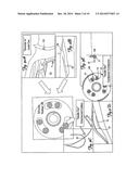 Detection of Implantable Lead Failures by Differential EGM Analysis diagram and image