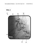 IMPLANTABLE ELECTRODE LOCATION SELECTION diagram and image