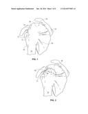 TENDON REPAIR IMPLANT AND METHOD OF ARTHROSCOPIC IMPLANTATION diagram and image