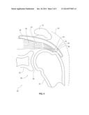 TENDON REPAIR IMPLANT AND METHOD OF ARTHROSCOPIC IMPLANTATION diagram and image