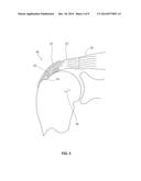 TENDON REPAIR IMPLANT AND METHOD OF ARTHROSCOPIC IMPLANTATION diagram and image