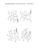 INTERVERTEBRAL IMPLANT diagram and image