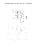 INTERVERTEBRAL IMPLANT diagram and image