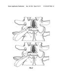 INTERVERTEBRAL IMPLANT DEVICES diagram and image