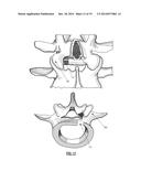 INTERVERTEBRAL IMPLANT DEVICES diagram and image