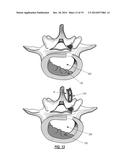 INTERVERTEBRAL IMPLANT DEVICES diagram and image