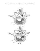 INTERVERTEBRAL IMPLANT DEVICES diagram and image