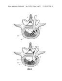 INTERVERTEBRAL IMPLANT DEVICES diagram and image