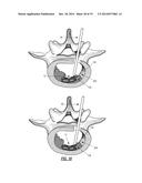 INTERVERTEBRAL IMPLANT DEVICES diagram and image