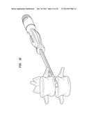 SURGICAL IMPLANT WITH GUIDING RAIL diagram and image