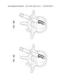 SURGICAL IMPLANT WITH GUIDING RAIL diagram and image