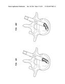 SURGICAL IMPLANT WITH GUIDING RAIL diagram and image