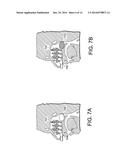 METHODS, DEVICES AND SYSTEMS FOR INCREASING THE EFFECTIVENESS OF     ULTRASOUND AND OTHER TISSUE TREATMENT MODALITIES diagram and image