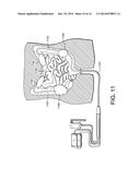 METHODS, DEVICES AND SYSTEMS FOR INCREASING THE EFFECTIVENESS OF     ULTRASOUND AND OTHER TISSUE TREATMENT MODALITIES diagram and image