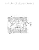 METHODS, DEVICES AND SYSTEMS FOR INCREASING THE EFFECTIVENESS OF     ULTRASOUND AND OTHER TISSUE TREATMENT MODALITIES diagram and image