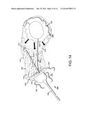 METHODS, DEVICES AND SYSTEMS FOR INCREASING THE EFFECTIVENESS OF     ULTRASOUND AND OTHER TISSUE TREATMENT MODALITIES diagram and image