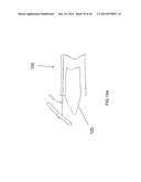 Unitary Endoscopic Vessel Harvesting Devices diagram and image