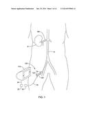 RENAL DENERVATION BALLOON CATHETER WITH RIDE ALONG ELECTRODE SUPPORT diagram and image