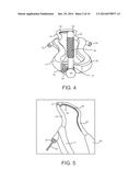 MINIMALLY INVASIVE DEVICE FOR SURGICAL OPERATIONS diagram and image