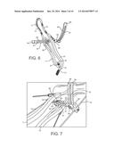 MINIMALLY INVASIVE DEVICE FOR SURGICAL OPERATIONS diagram and image