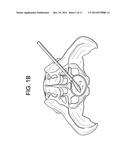 Cortical Rim-Supporting Interbody Device diagram and image