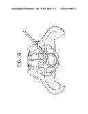 Cortical Rim-Supporting Interbody Device diagram and image