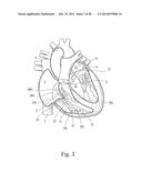 Percutaneous Valve Repair by Reshaping and Resizing Right Ventricle diagram and image