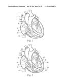 Percutaneous Valve Repair by Reshaping and Resizing Right Ventricle diagram and image